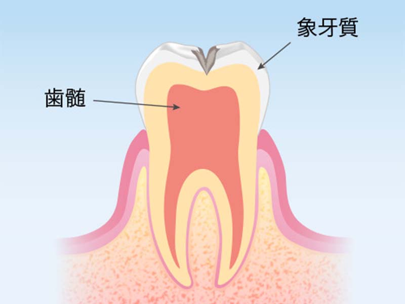 C2（象牙質の虫歯）