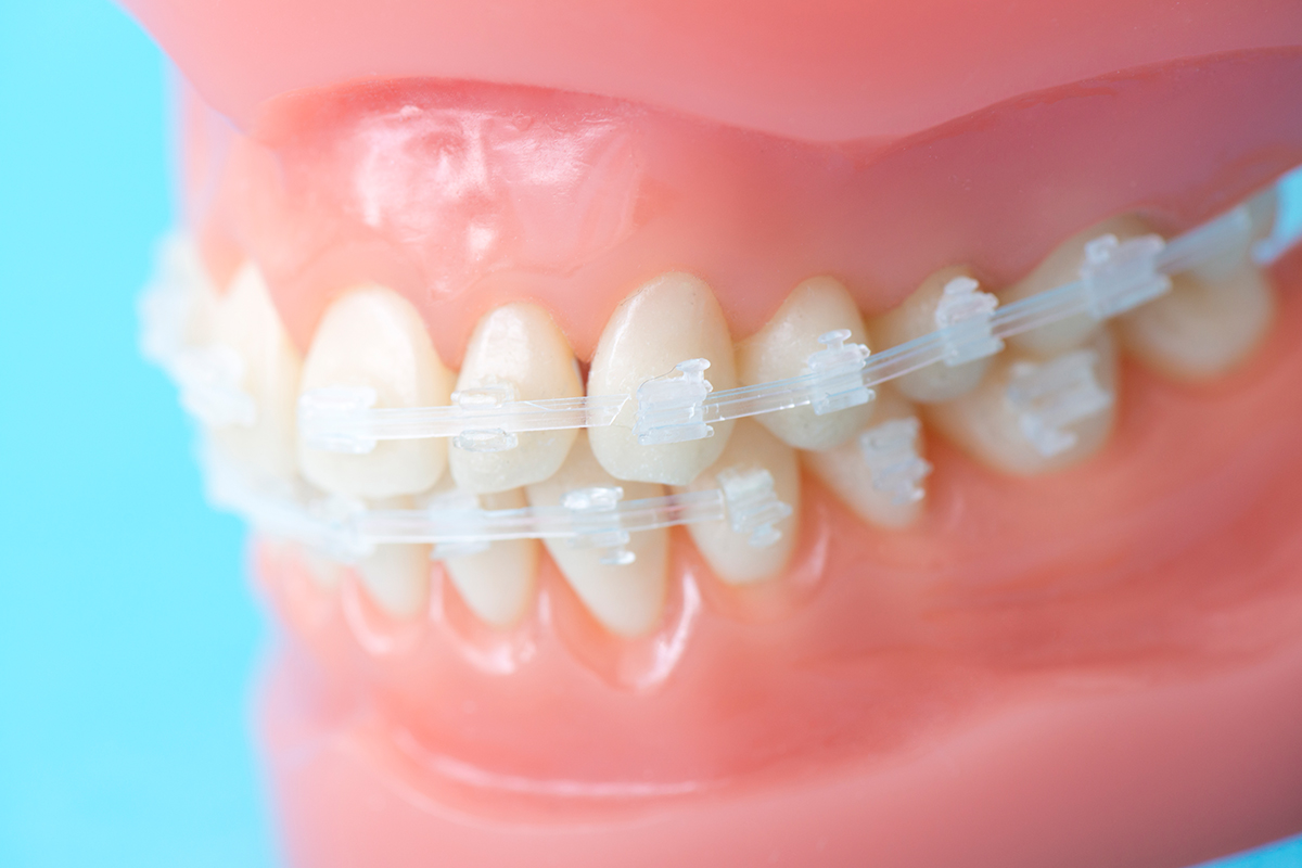 歯並びのコンプレックスやお悩みは……矯正歯科