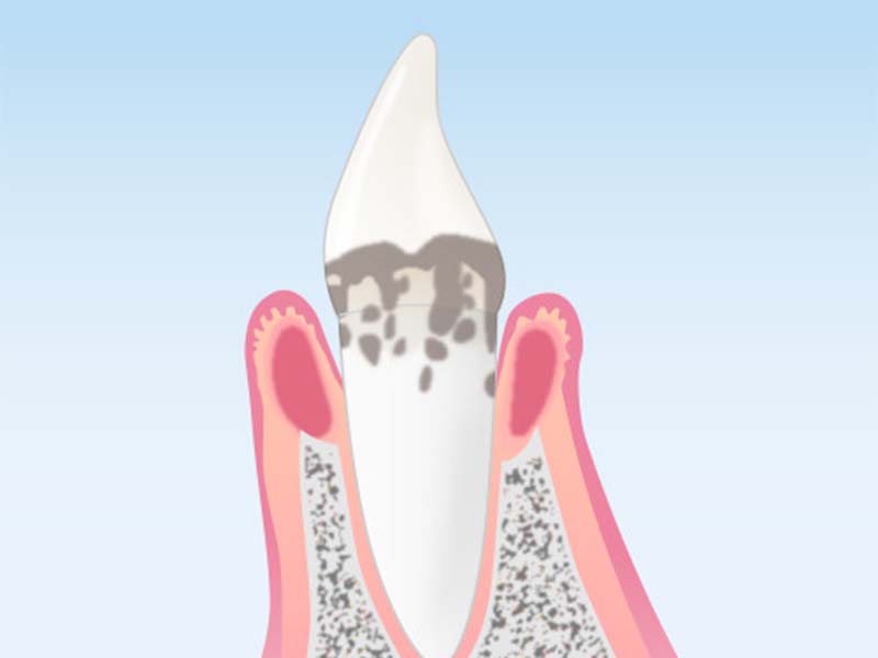 歯を失う原因の第一位は“歯周病”!?