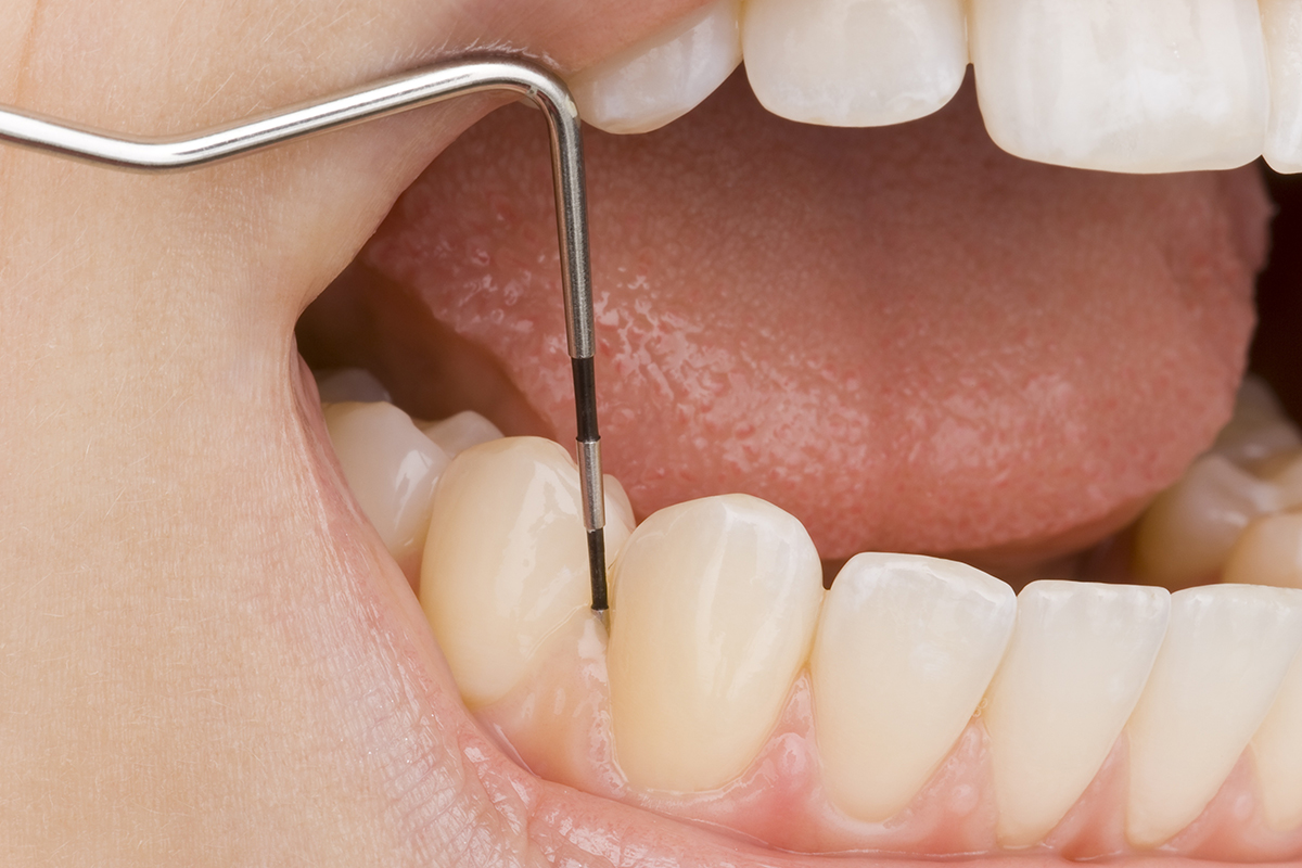 歯ぐきからの出血・腫れ、歯のグラつきがあるなら……歯周病治療